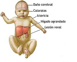 Description de l'image Bebe Galactosemia.jpg.