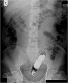 Vibrator stuck in the rectum can be seen on this abdominal X-ray.