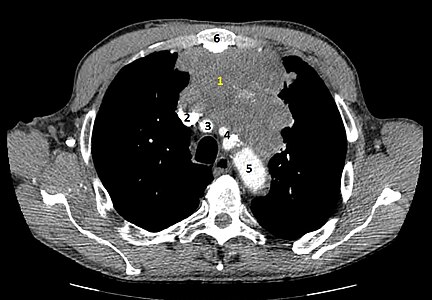 Coupe tomodensitométrique montrant une tumeur hétérogène envahissant localement les structures voisines. Le fenêtrage médiastinal et l'injection de produit de contraste permettent de voir au mieux le contact étroit avec les vaisseaux.