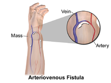 Schéma d'une fistule artério-veineuse