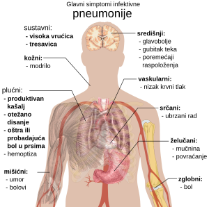 A diagram of the human body outlining the key symptoms of pneumonia