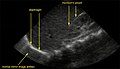 A normal ultrasonographic view of Morison's pouch. The bright line is the capsule of the kidney; there is no fluid present and hence no visible space.
