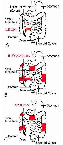 Diagram of the three most common sites of intestinal involvement in Crohn's disease.