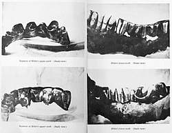 Four achromatic photographs: the left two are of a metal maxillar bridge, the right two of a jawbone fragment with dental work sundered around the alveolar process.
