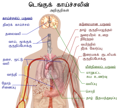 Outline of a human torso with arrows indicating the organs affected in the various stages of dengue fever