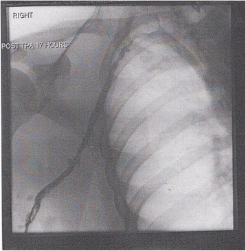 After treatment with catheter-directed thrombolysis, blood flow in the axillary and subclavian vein were significantly improved. Afterwards, a first rib resection allowed decompression. This reduces the risk of recurrent DVT and other sequelae from thoracic outlet compression.[147]