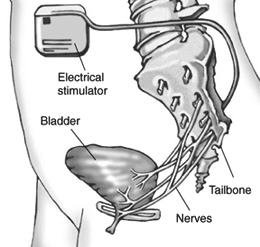 Illustration showing the placement of the sacrla nerve stimulator in the abdomen in relation to the bladder, sacral nerves and lower spine.