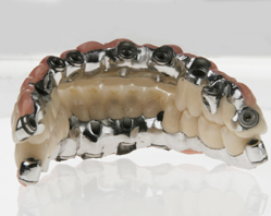 Totale Gebissrekonstruktion auf Zahnimplantaten, von oral – die Gesamtkonstruktion ist zu Pflege- und Wartungszwecken abnehmbar