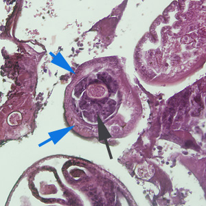 Stichocyte (zwarte pijl) en bacillaire banden (blauwe pijlen) van Capillaria hepatica