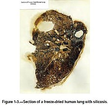 Lung of a patient with Silicosis showing severe scarring