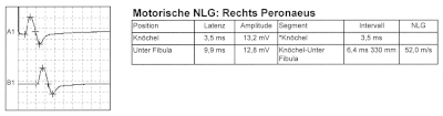 Normale motorische Neurografie am N. peronaeus