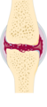 Osteoarthritis and rheumatoid arthritis - Osteoarthritis