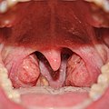 Anterior photograph of the oral cavity showing palatine tonsils (inflamed) and uvula