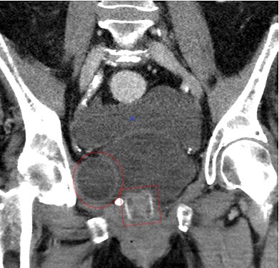 CT-Scan (koronale Rekonstruktion) zeigt ein AMS 800 bei einer Frau