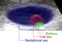 Artificially colored, showing gestational sac, yolk sac and embryo (measuring 3 mm as the distance between the + signs)