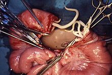 Παράδειγμα ασκαρίασης - Δύσκολη χειρουργική επέμβαση στη Νότιο Αφρική σε ένα κομμάτι του εντέρου που πλήχθηκε απο γάγγραινα και έπρεπε να αποκοπεί. Ζωντανά σκουλήκια αναδύονται.