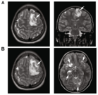 Granulomatous amoebic encephalitis