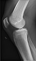 Right knee, lateral (with minimal patellar osteophyte)