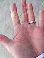 Raynaud's Left Hand