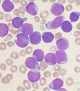 Acute lymfatische leukemie