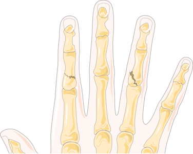 On the index finger, a fracture of the shaft that does not affect the joint. On the right, a fracture affecting the ring finger's proximal interphalangeal joint, or PIP joint