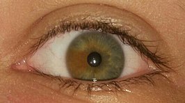 Heterochromia iridis