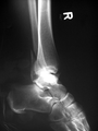 Eine Bimalleolarfraktur im seitlichen Röntgenbild …