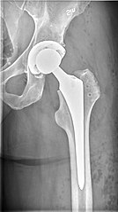 Anteroposterior image. Focal postoperative radiolucent emphysematous spots are visible.