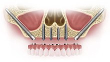 Implanturi dentare zigomatice