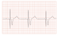 ECG showing en:Pacemaker syndrome