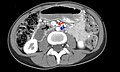 Abdominal and pelvic computed tomography scan showing duodenal compression (black arrow) by the superior mesenteric artery (red arrow) and the abdominal aorta (blue arrow).