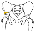 Salter-Osteotomie, Schritt 4