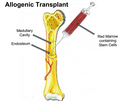 1. Needle is inserted into the upper leg, through the skin and into the Medullary Cavity, where the red marrow is stored and harvested 2. Stem cells from the marrow are then concentrated and prepared for freezing in a laboratory. 3. Patient undergoes chemotherapy to rid the body of any harmful viruses, bacteria or cancer cells.4. Patient is infused with the Donor's blood which contains the stem cells.Image by Rebecca Leathers - User:mugwump12 and added to article [[Bone Marrow Transplant]]