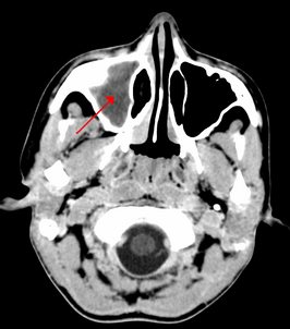 Kaakholte-ontsteking. De sinus maxillaris (rode pijl) is licht gekleurd door ontstoken slijmvlies en vocht in de holte. Normaal zijn de holten op de foto donkerder dan het omgevende bot omdat er lucht in zit.