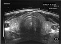 Abb. 3 Ultraschallbild: Schilddrüse im Querschnitt