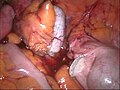 Appendix vermiformis nach der Abtrennung mit dem Stapler