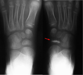 Ziekte van Köhler bij een 8 jaar oud meisje. Bij het pijltje is te zien dat het bot bijna verdwenen is. (Vergelijk de andere, gezonde voet.)