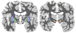 Weergave van een coronale doorsnede van de menselijke hersenen. Aangegeven zijn de basale ganglia, bestaande uit: het neostriatum (blauw), de globus pallidus (groen), de nucleus subthalamicus (geel) en de substantia nigra (rood).