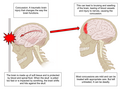 A concussion is traumatic brain injury that changes the way your brain functions. When the skull is jolted or impacted by a hard surface, the brain shifts, slamming against the skull, causing damage and swelling to the brain. If treated correctly, brain will heal. But if not, results can be deadly.