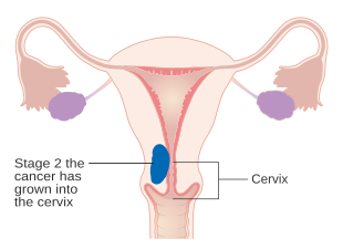 A diagram of stage II endometrial cancer