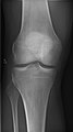 Right knee, anteroposterior