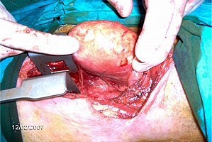 Eine linksseitige Lobektomie der Schilddrüse nach Sternotomie zur Entfernung einer kalzifizierten Kapsel am linken Schilddrüsenlappen.[15]