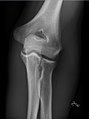 Left elbow, anteroposterior