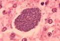 Histopathologie der exoerythrozytären Form eines Plasmodium-Parasiten in der Leber.