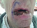 Large squamous-cell carcinoma (SCC) of lower lip