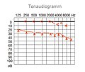 Tonaudiogramm, Schallleitungsstörung