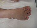 The right foot of a person with Langer–Giedion syndrome showing the characteristic features