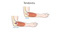 Tendonitis Tendon rupture