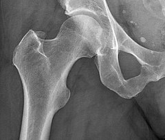 Cropped image of normal contralateral hip