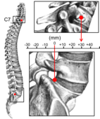 Sagittal balance